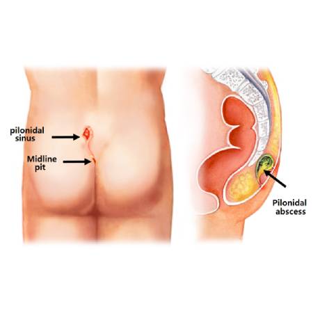 Pilonidal Sinus ayurvedic treatment